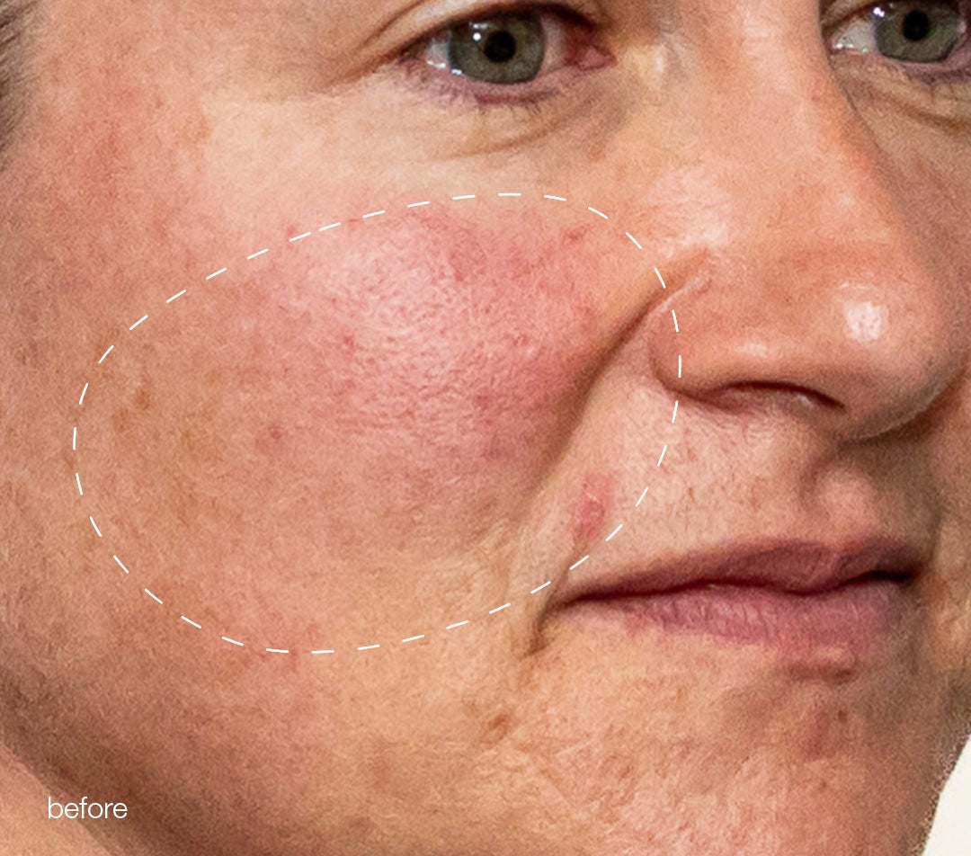 melanopro peel system