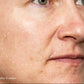 melanopro peel system