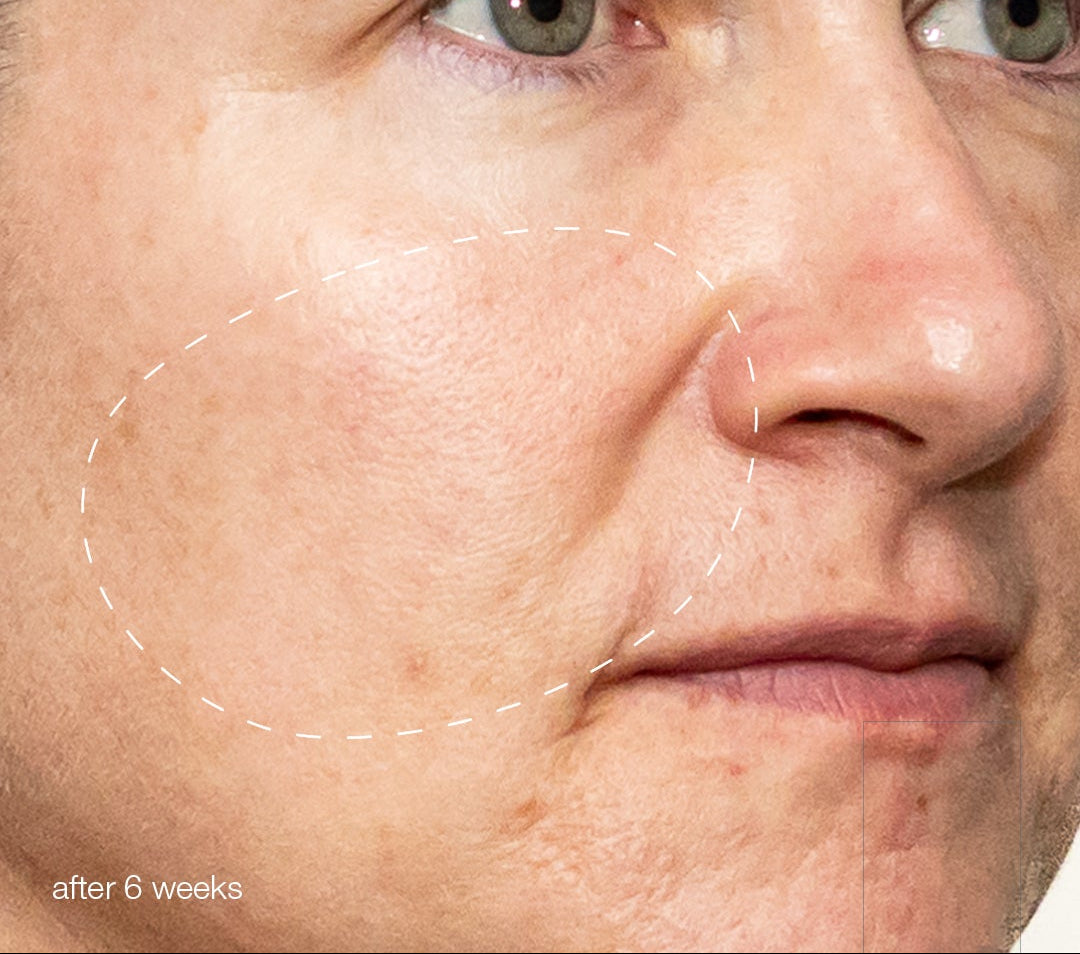melanopro peel system