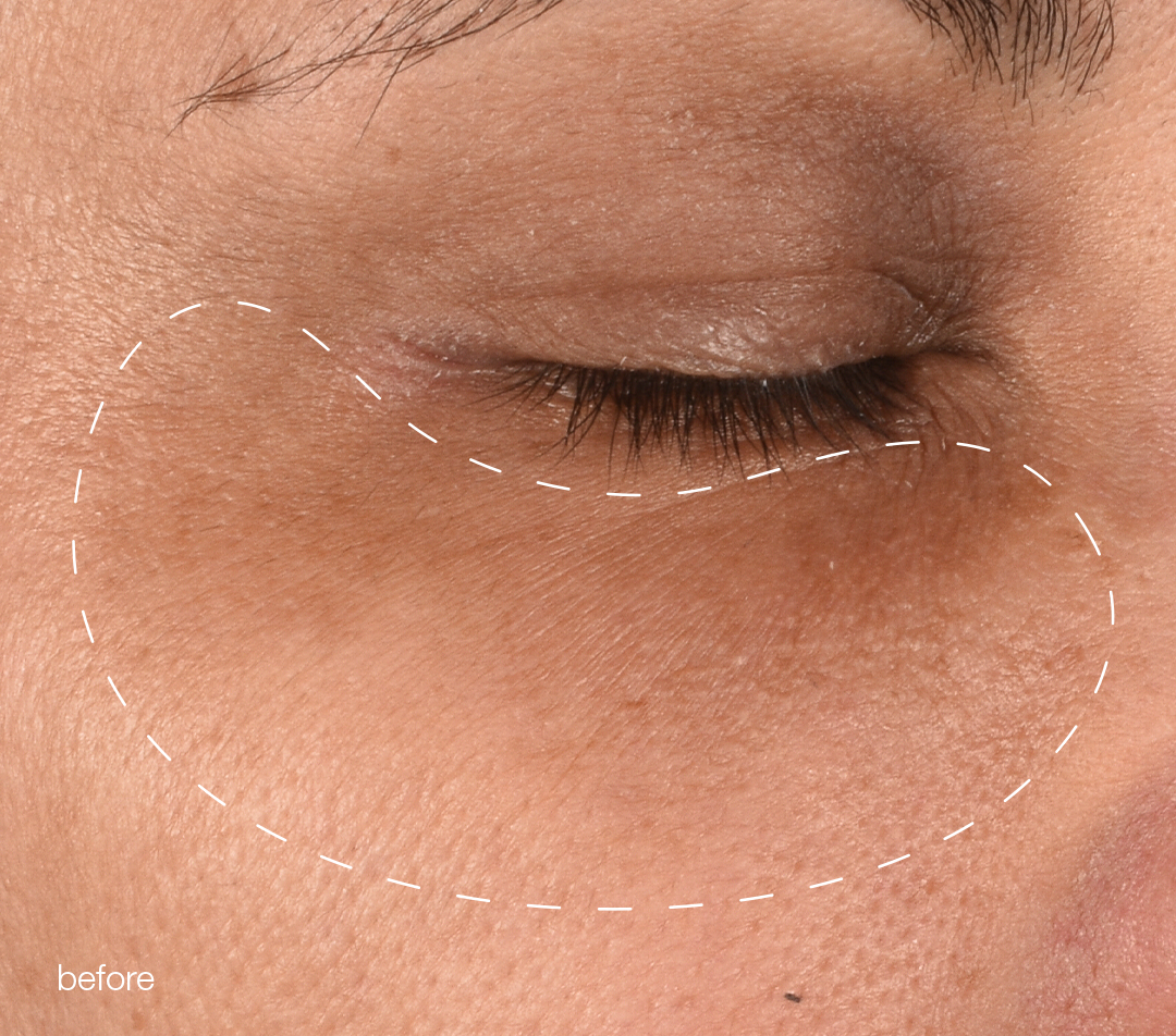 melanopro peel system