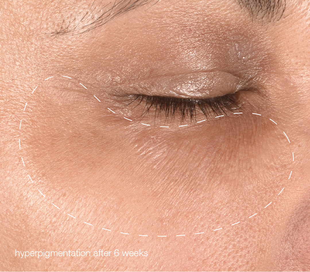 melanopro peel system