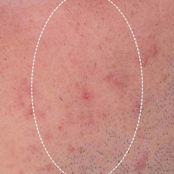 micro-exfoliant quotidien - Before
