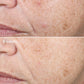 retinol acne clearing oil